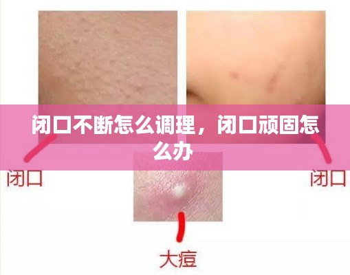 闭口不断怎么调理,闭口顽固怎么办