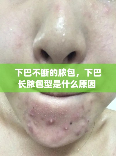 下巴不断的脓包,下巴长脓包型是什么原因
